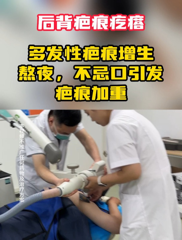 小伙后背痘痘,平时熬夜、饮食不注意,痘痘长出肉疙瘩!