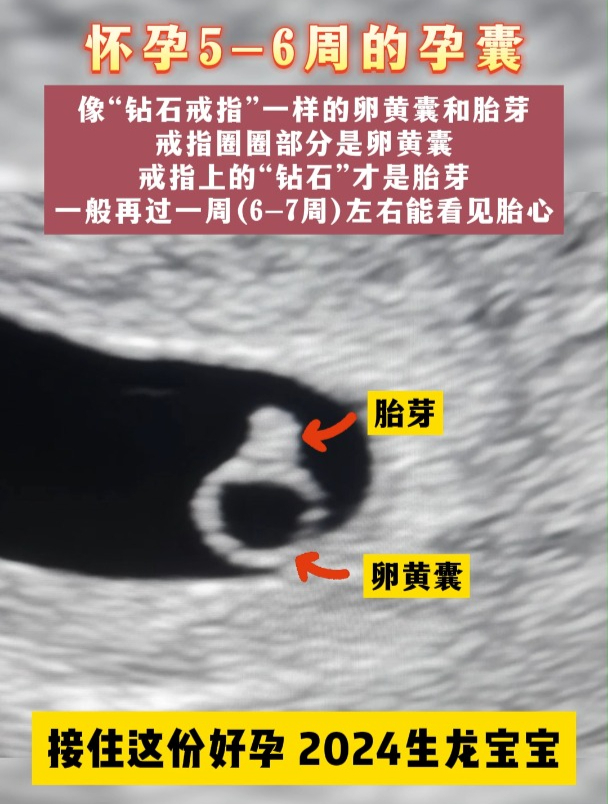 怀孕5-6周的孕囊 像“钻石戒指”一样的卵黄囊和胎芽～祝见者好孕