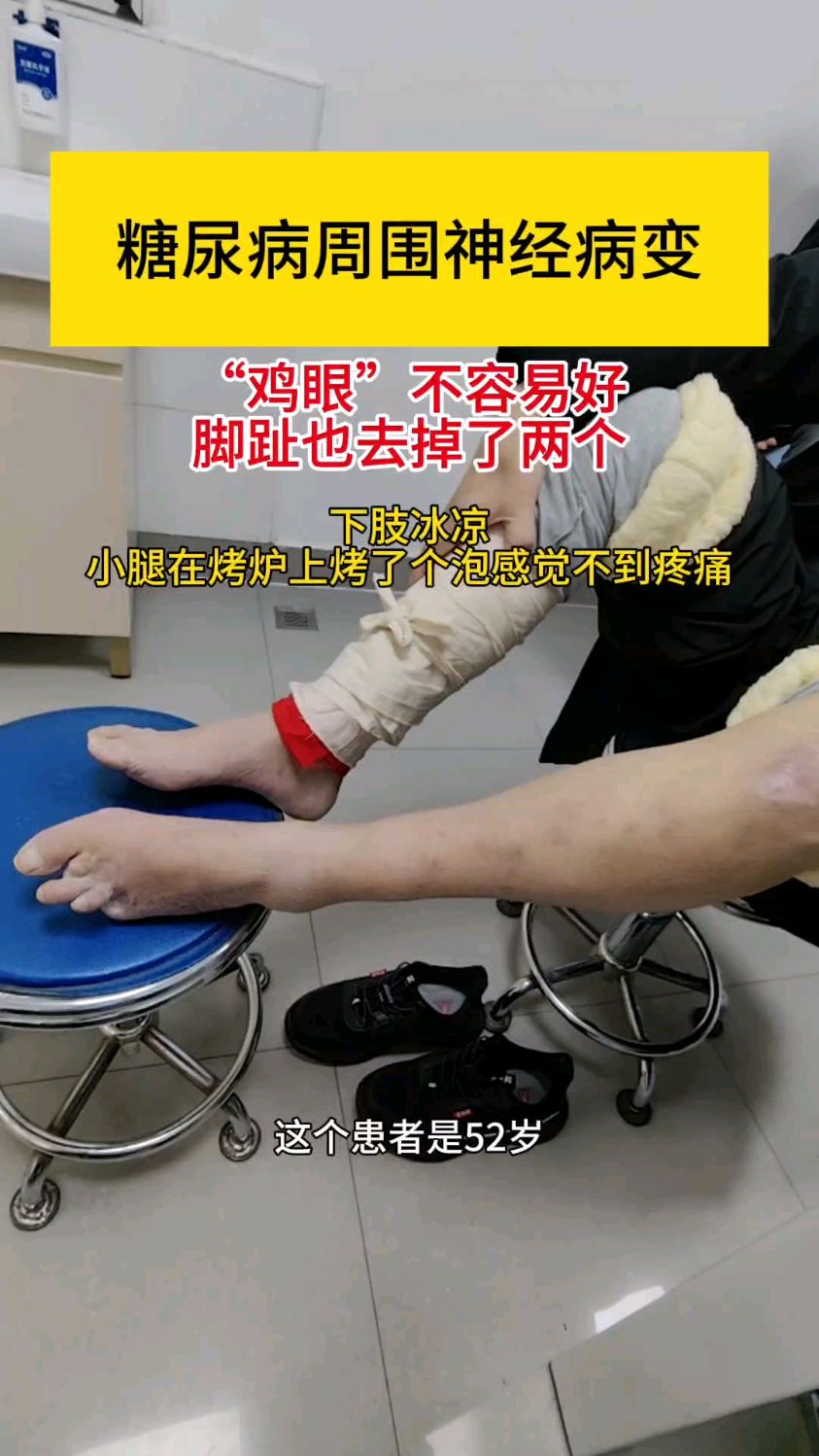 小腿在烤炉上烤了个泡竟然感觉不到疼痛