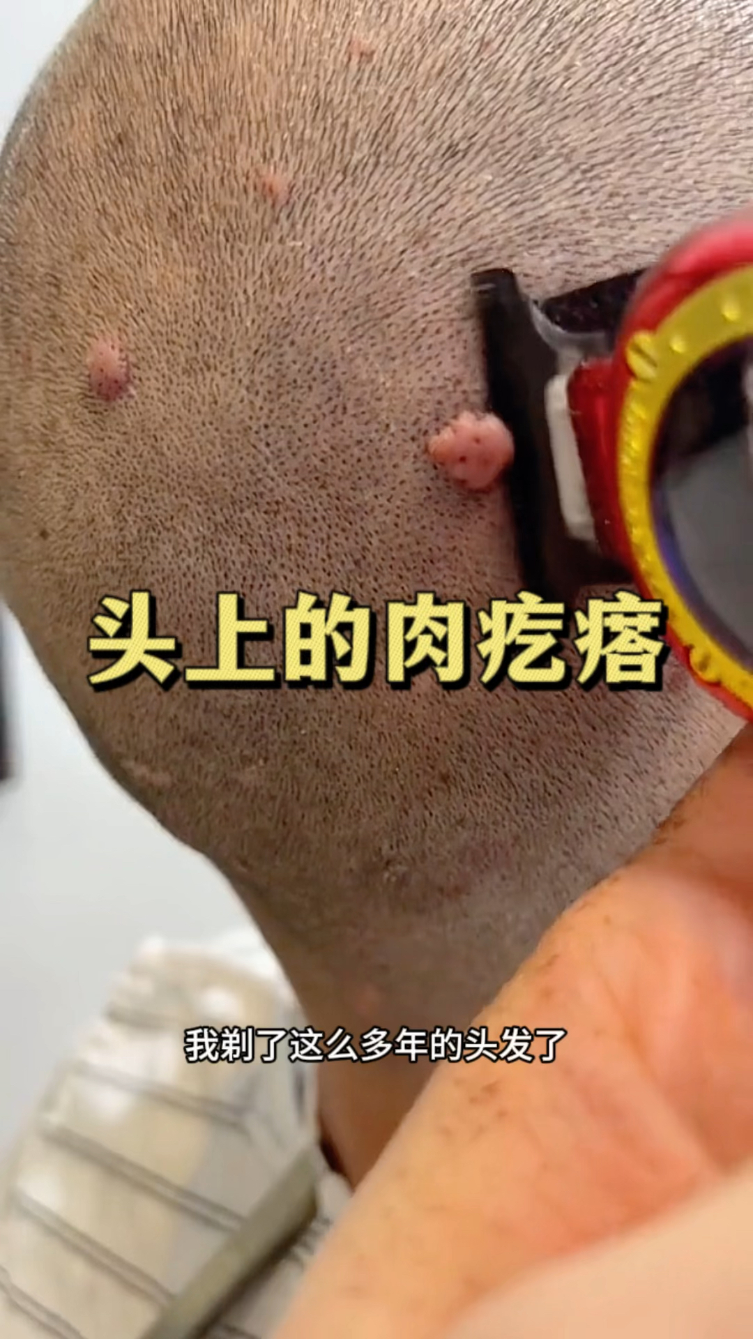 头上的肉疙瘩,理发的时候特别困难