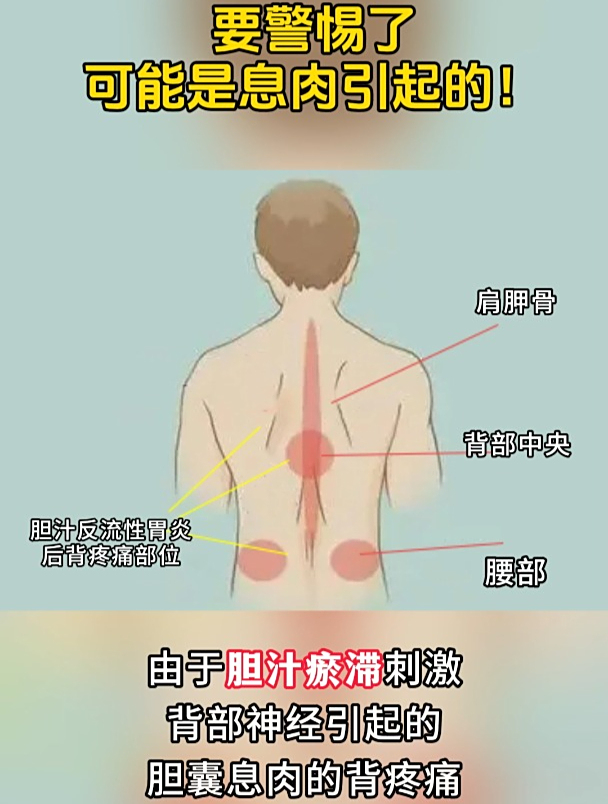 长期后背疼,要警惕了,可能是息肉引起的