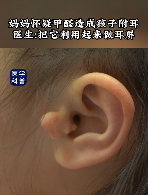 宝宝耳朵上长了肉球,妈妈怀疑是孕期甲醛导致