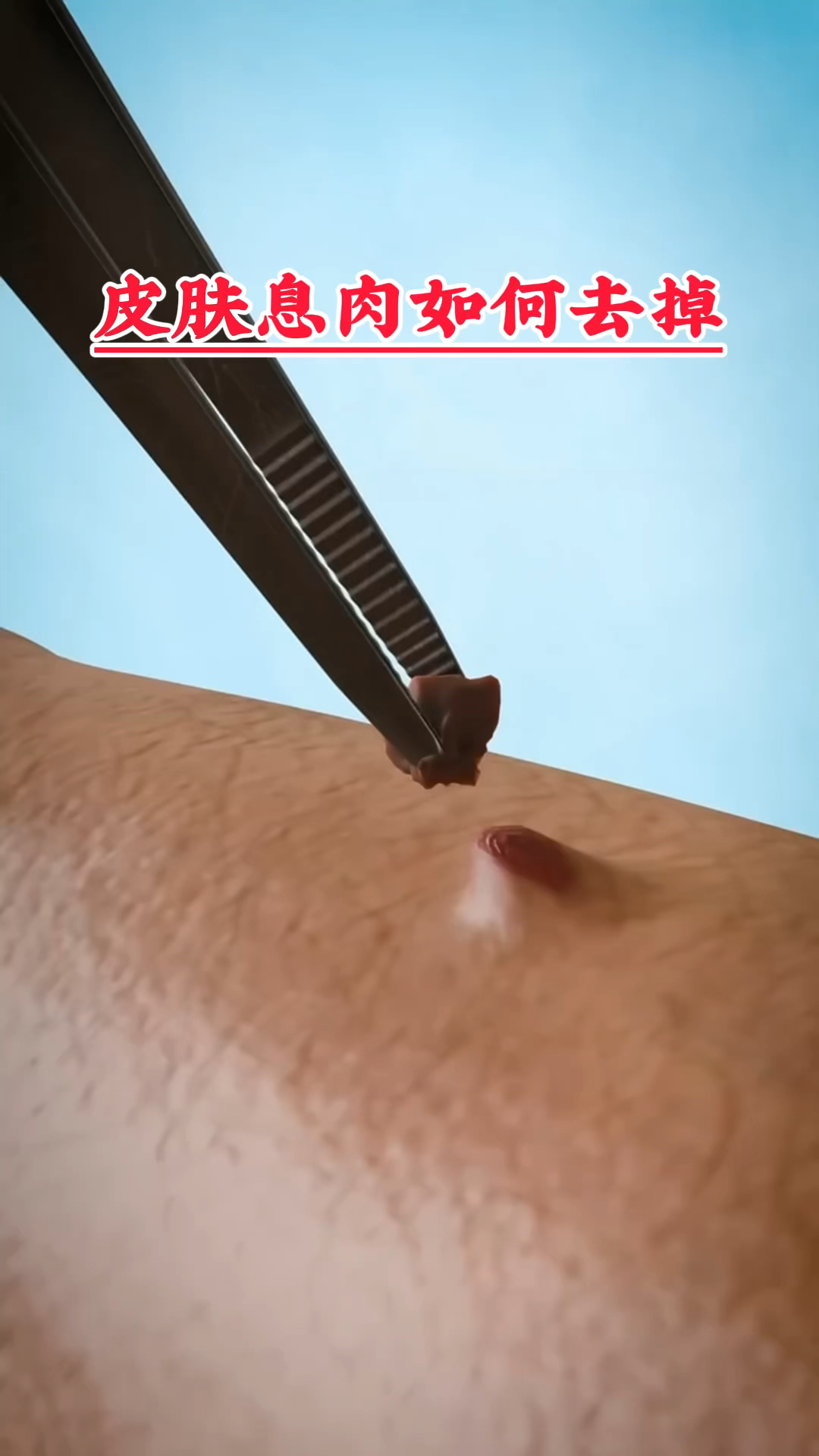 皮肤上的息肉如何去除