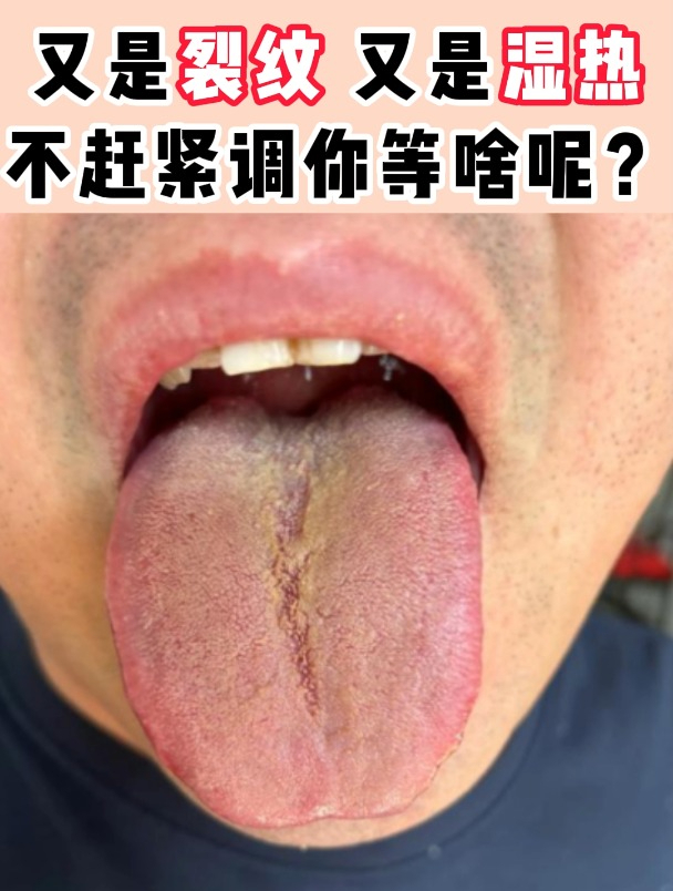 这舌头又是裂纹,又是湿热,真不知道你在等什么