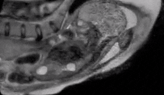 女人生孩子X光片（GIF图）