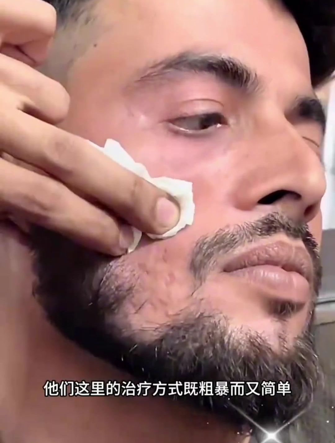 外国老表脸上长了肉疙瘩,祛了之后直接变成坑!