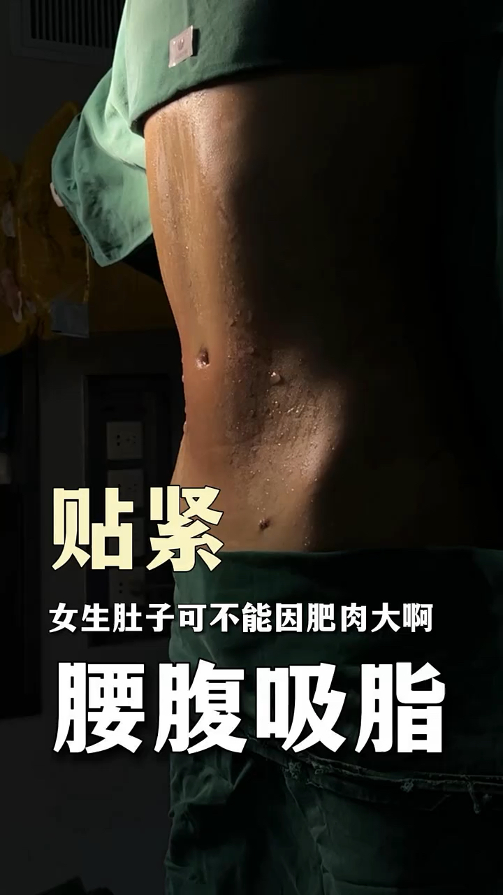 女生肚子可不能因肥肉大啊,腰腹吸脂术后变成小蛮腰