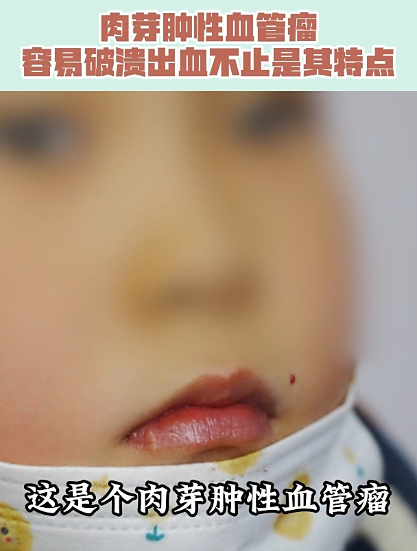 肉芽肿性血管瘤容易破溃出血不止是其特点