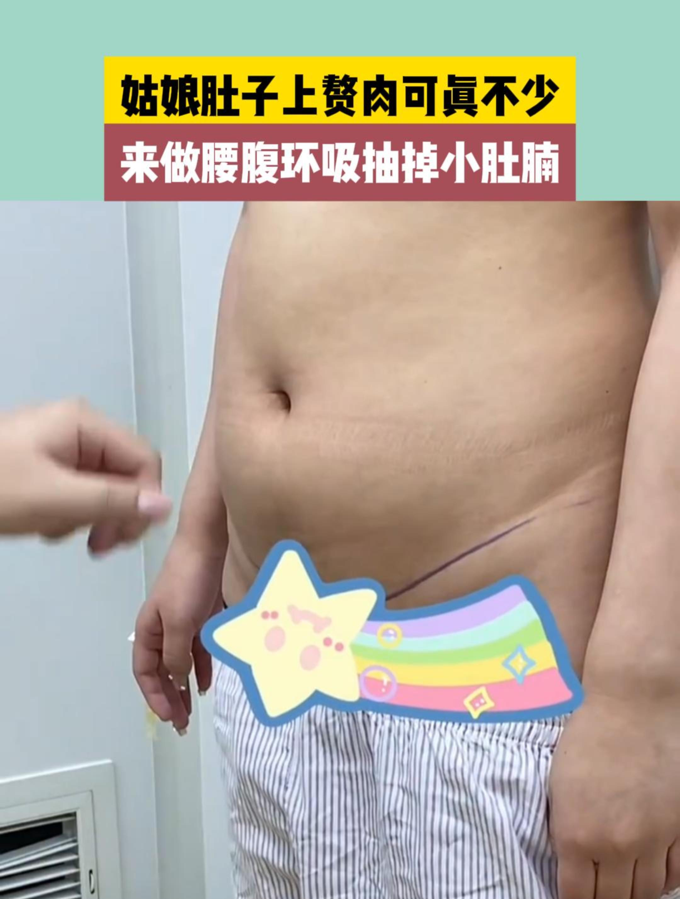 姑娘肚子上赘肉可真不少,来做腰腹环吸抽掉小肚腩