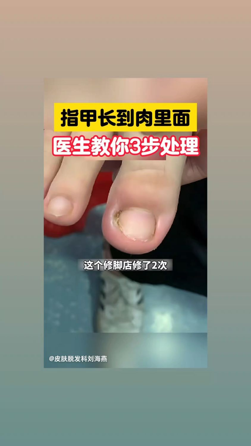 指甲长到肉里3步处理