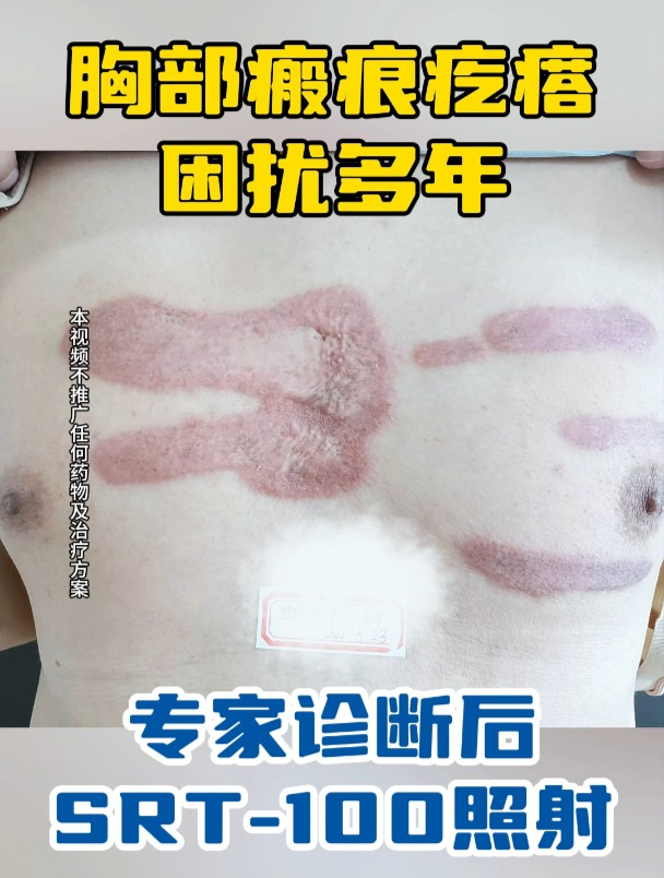 小伙胸口上长疤痕疙瘩,自述在不断长大!
