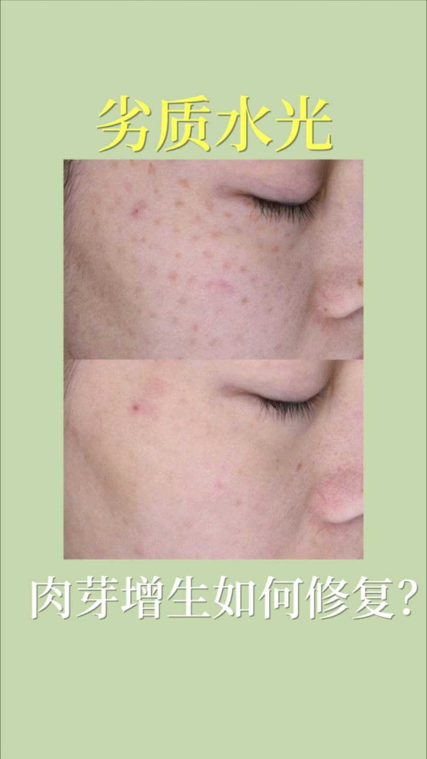 打劣质水光导致满脸肉芽肿,该如何正确修复