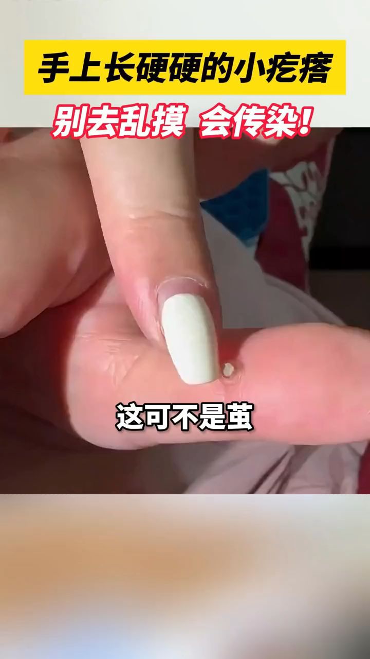 寻常疣正确处理方式