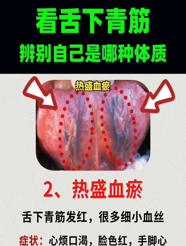 舌头下边两条“青筋”,发黑发粗,到底是什么原因引起的?