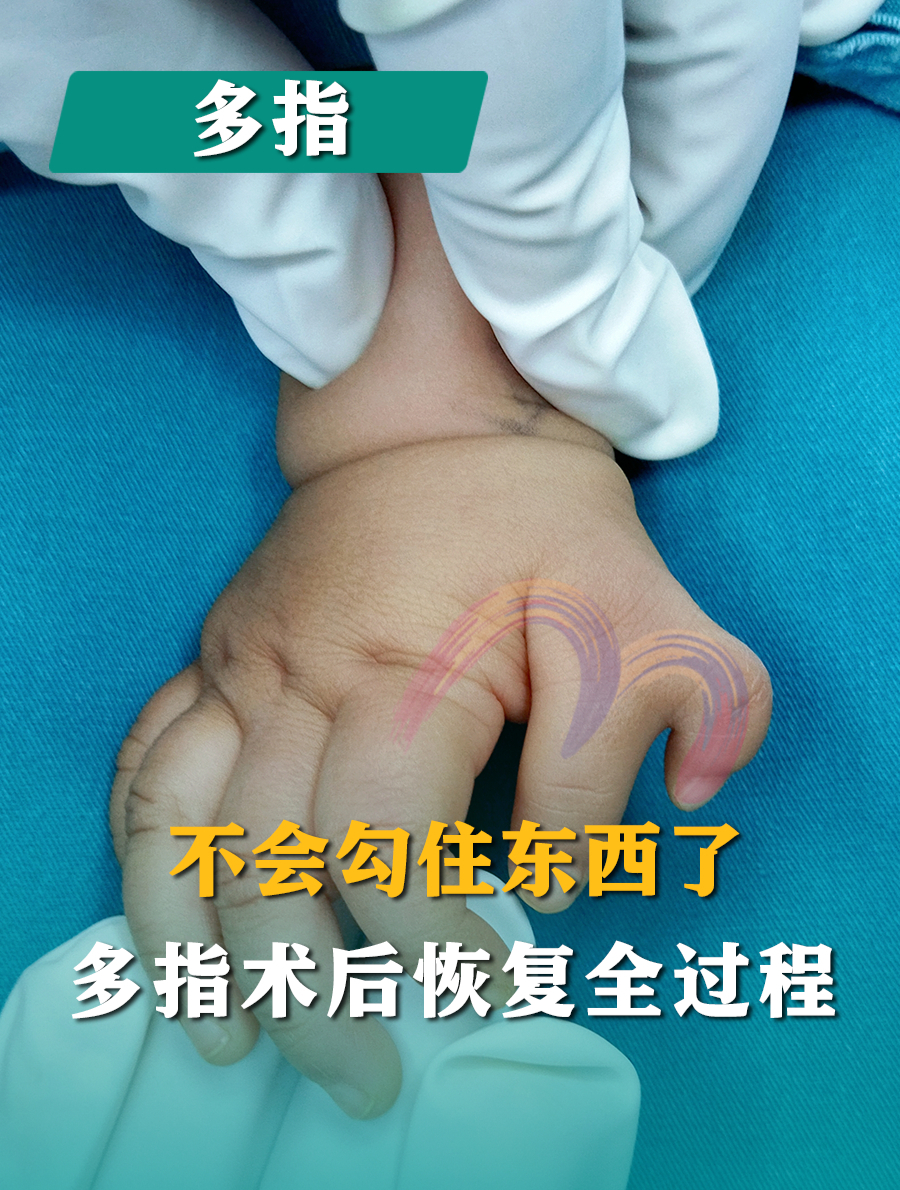 7个月大宝宝拇指多指,抓握很不方便,术后2个月捏小馒头没问题
