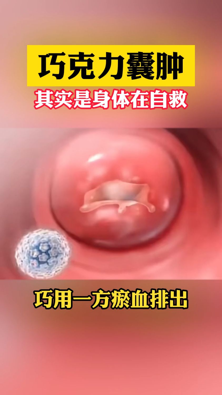 巧克力囊肿,其实是身体在自救,巧用一方排出