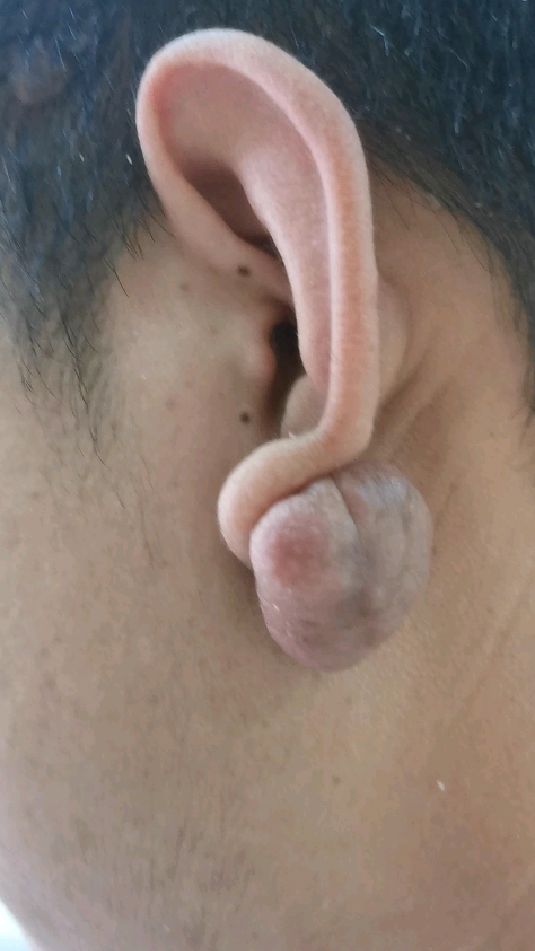 穿耳洞,打耳钉,长肉疙瘩!