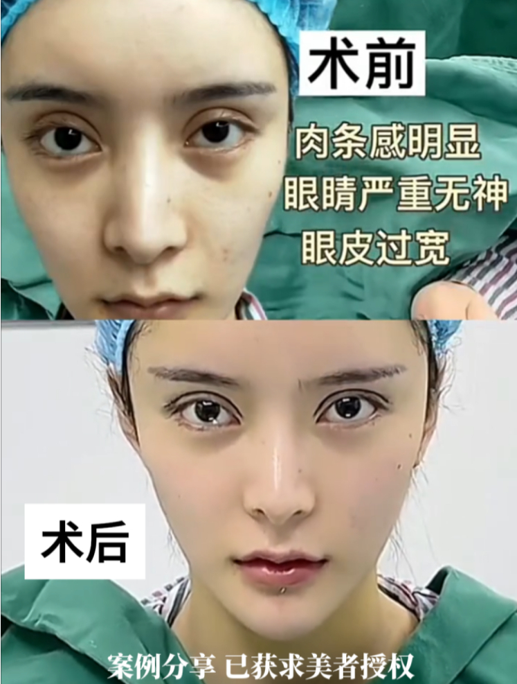 姑娘双眼无神肉条感明显 双眼皮术后 灵动自然气质蜕变!