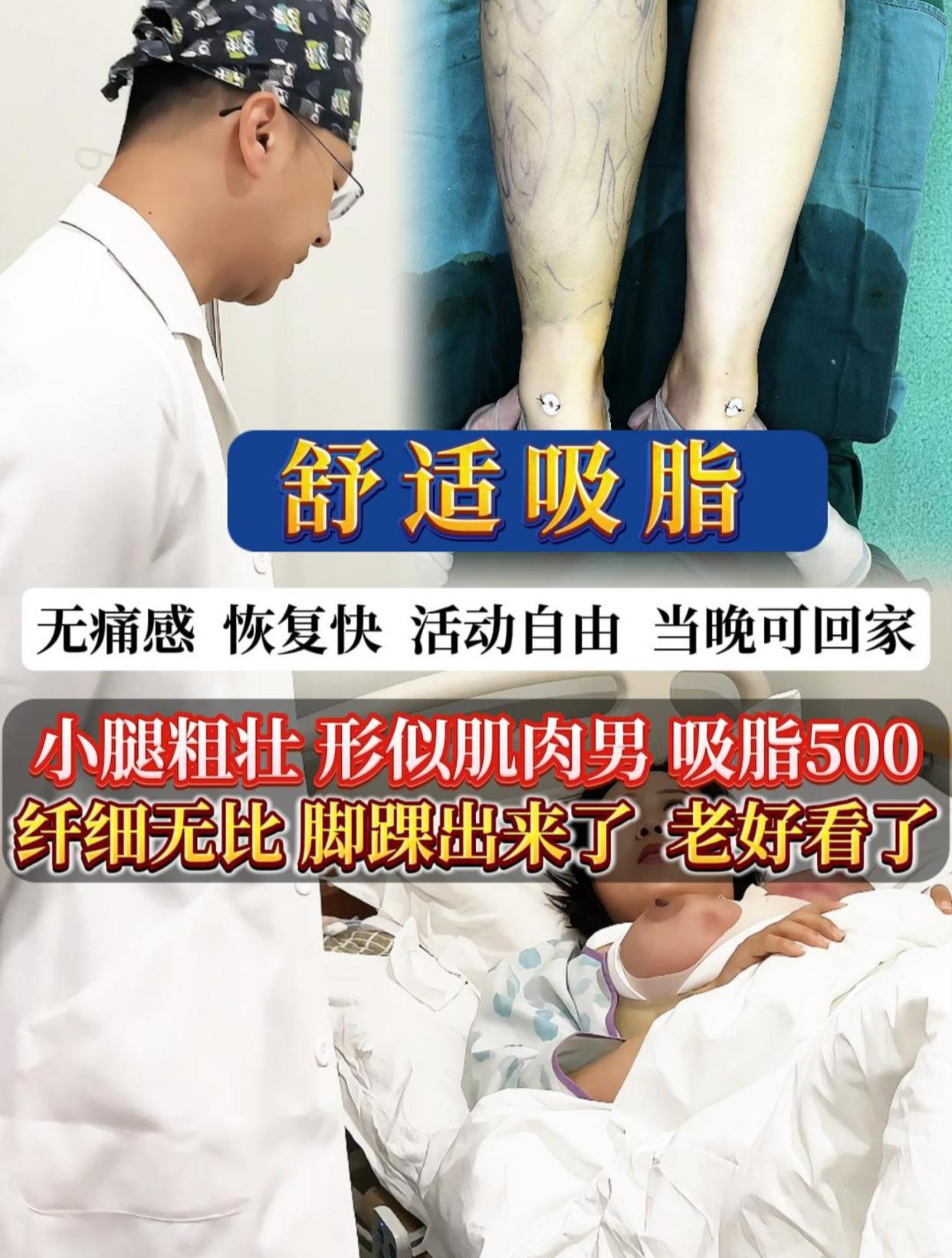 小腿粗壮 形似肌肉男 吸脂500ml 纤细无比 脚踝显形了 老好看了