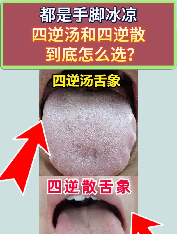 都是治手脚冰凉的,四逆汤和四逆散到底怎么选?