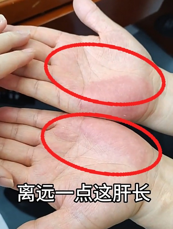 手诊分析:手掌小鱼际处发红,小心肝功能出现异常!