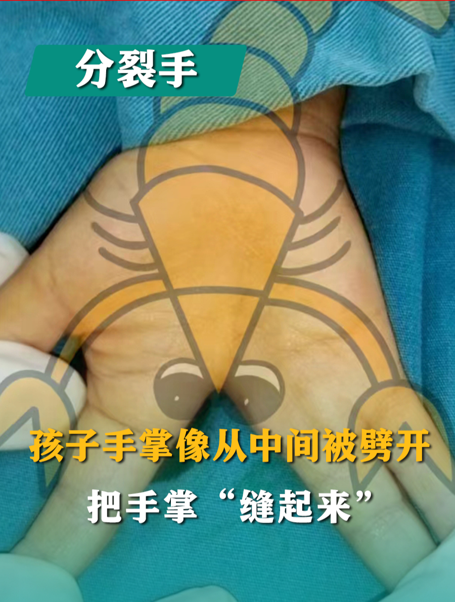 2岁男孩长了一只“龙虾手”,修复后,手好看了,抓握东西很方便