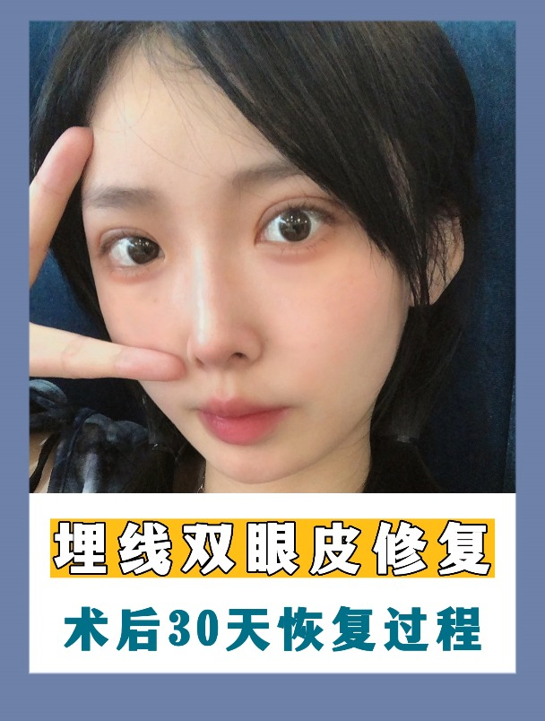 埋线双眼皮修复,术后30天分享~