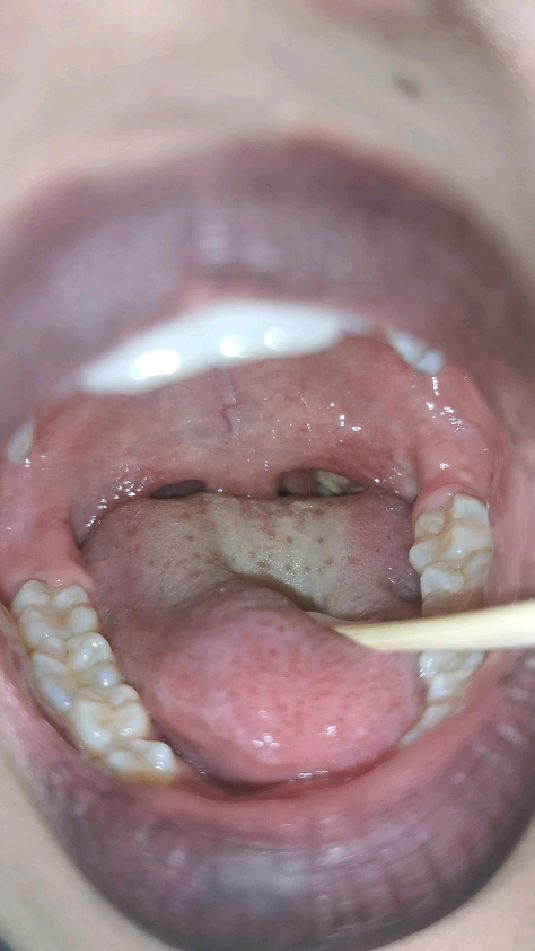 扁桃体真的发炎了!还有脓点!