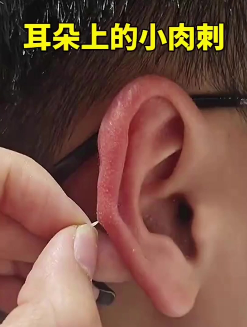 耳朵上的小肉刺,真想给他拽下来