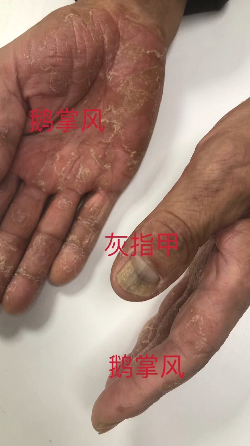 灰指甲、鹅掌风、脚气互相传染