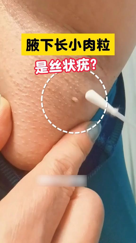 腋下长小肉粒是什么?