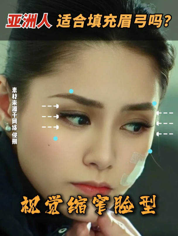 亚洲人适合填充眉弓吗?