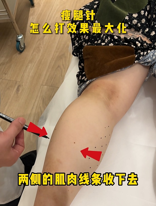 肉毒素注射:瘦小腿怎么打效果好