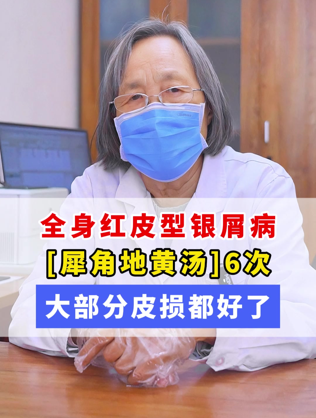 全身红皮型银屑病,「犀角地黄汤」,6次大部分皮损都好了!