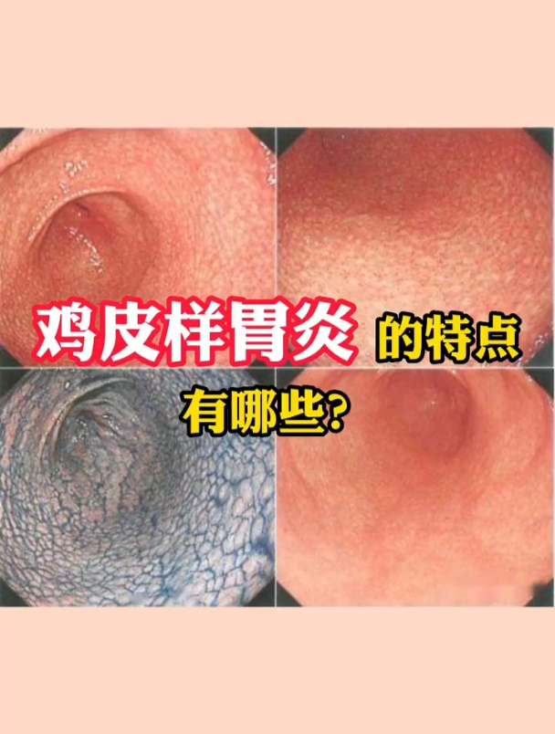鸡皮样胃炎的特点有哪些?