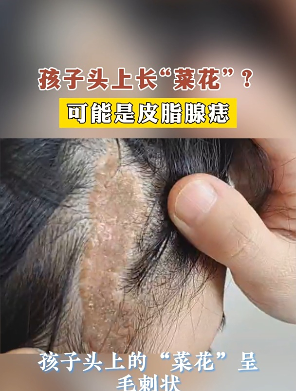 孩子头上长“菜花”?可能是皮脂腺痣