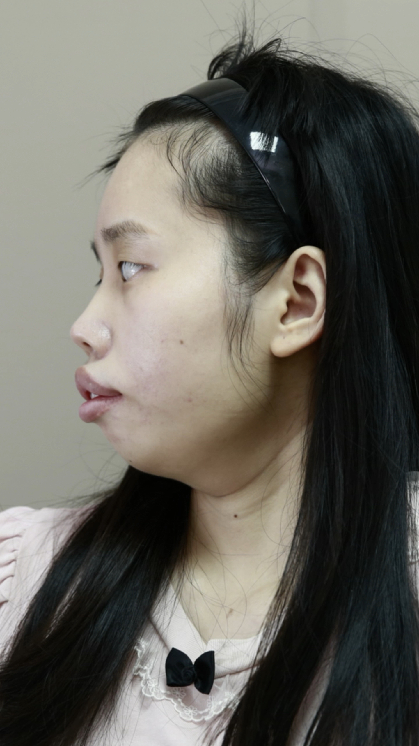 28岁骨性凸嘴矫正前:长的奇怪,矫正后:长的可爱