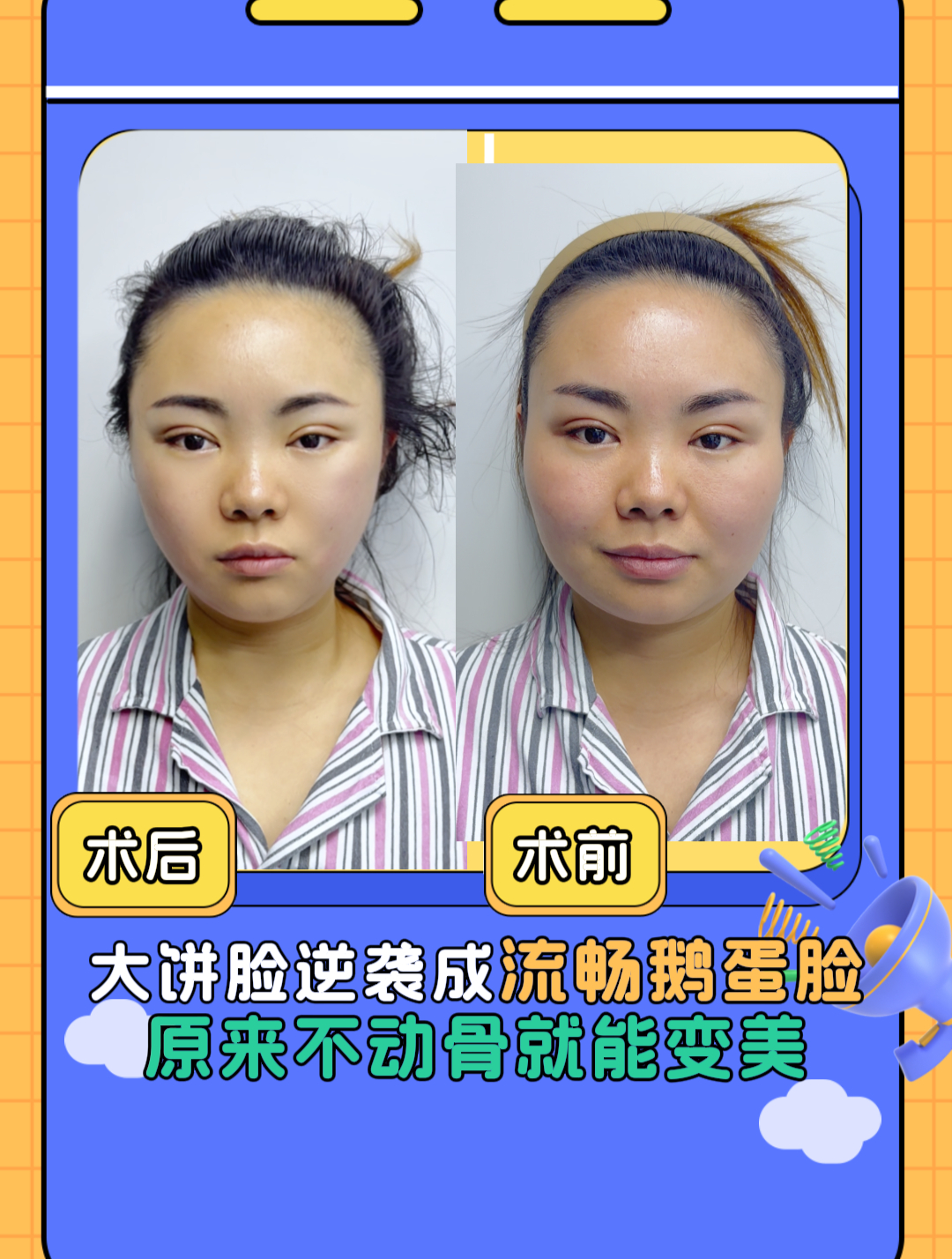 大饼脸逆袭成流畅鹅蛋脸,原来不动骨也能变美呀!