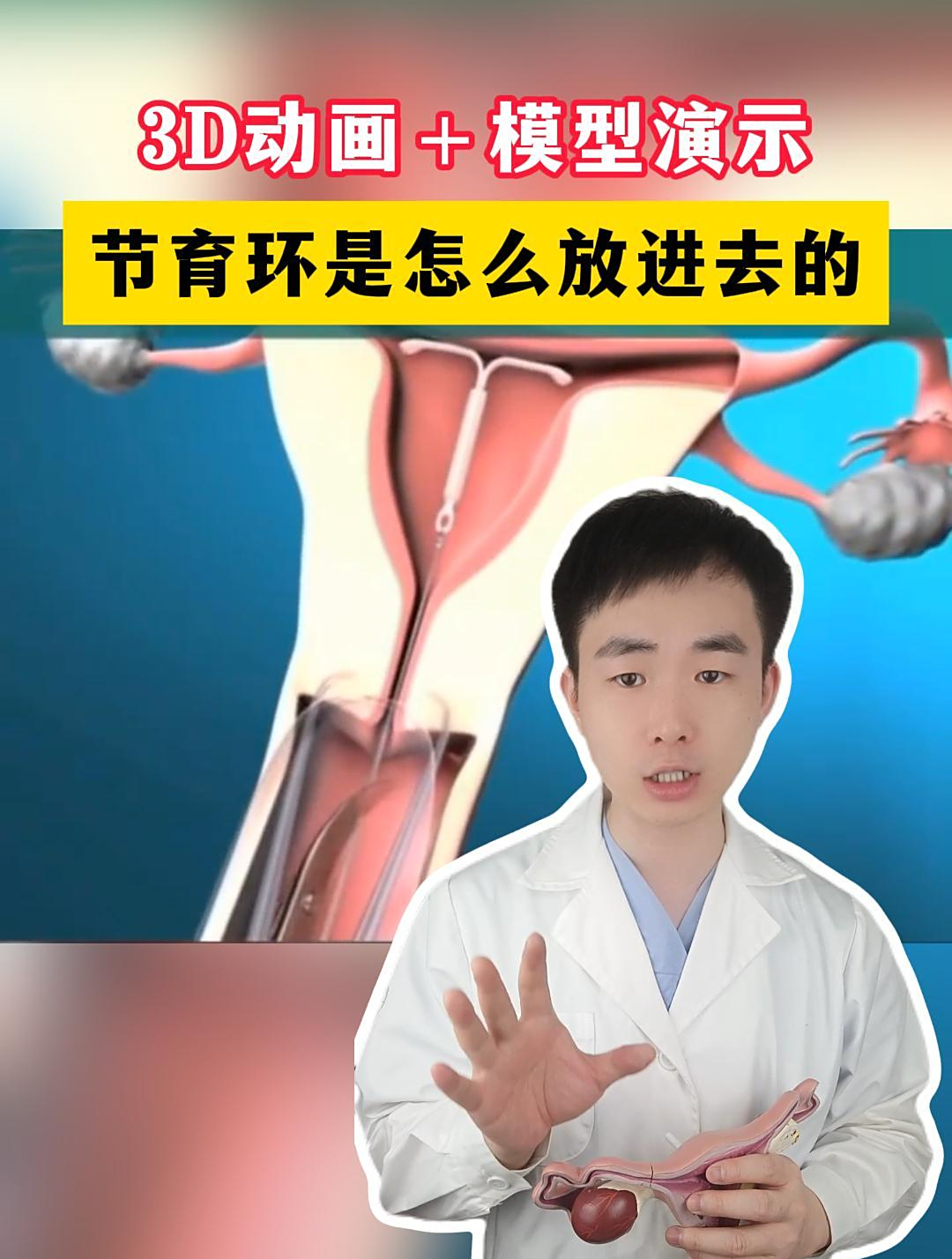 节育环是怎么放进女性体内的?