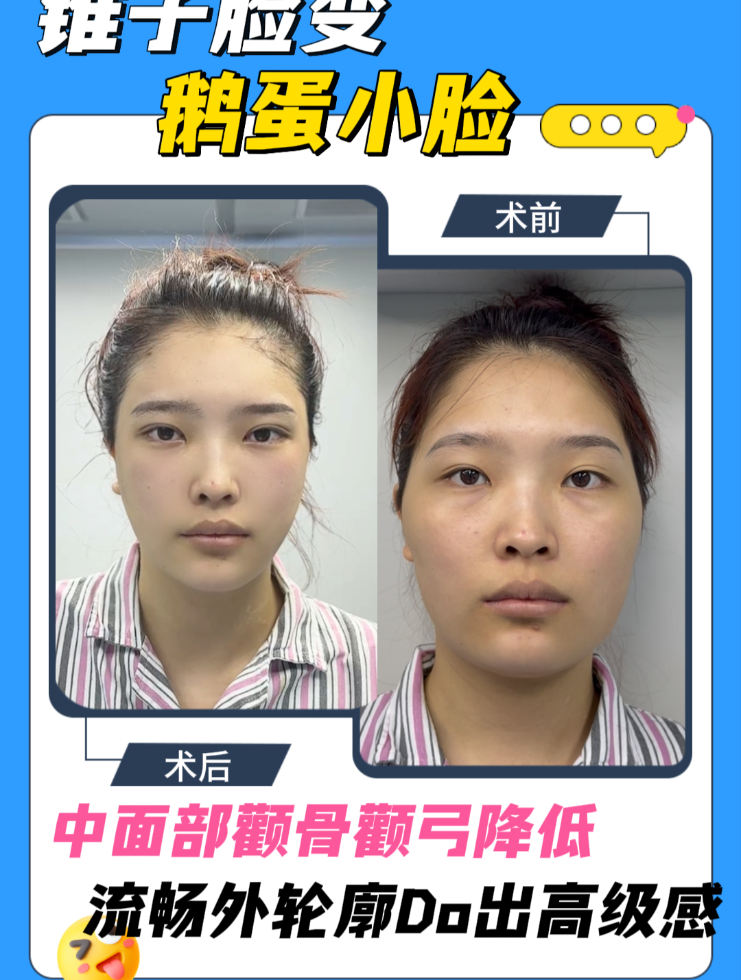 从锥子脸—鹅蛋脸,姑娘究竟做了什么?轮廓流畅显脸小!