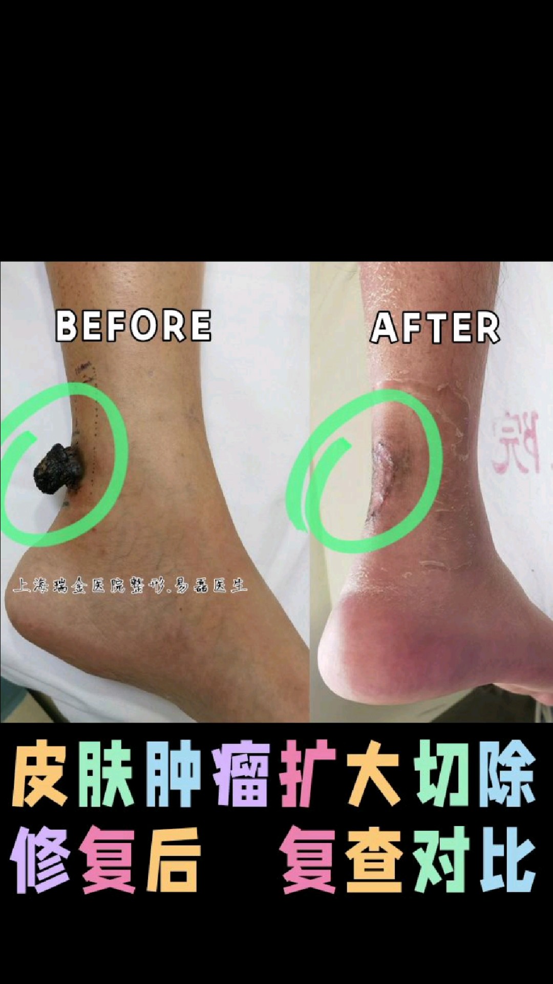 皮肤肿瘤为啥多见菜花状或蘑菇状?