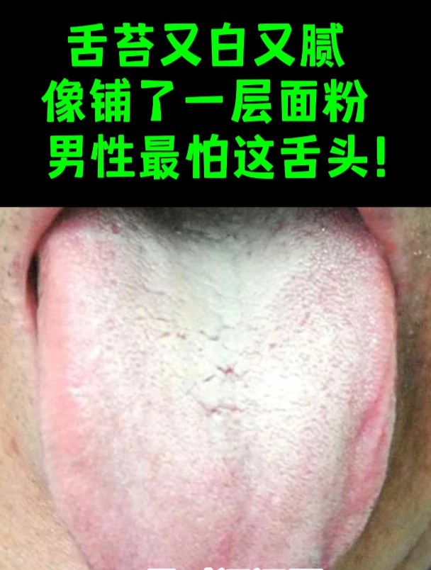 舌苔白腻是怎么回事?