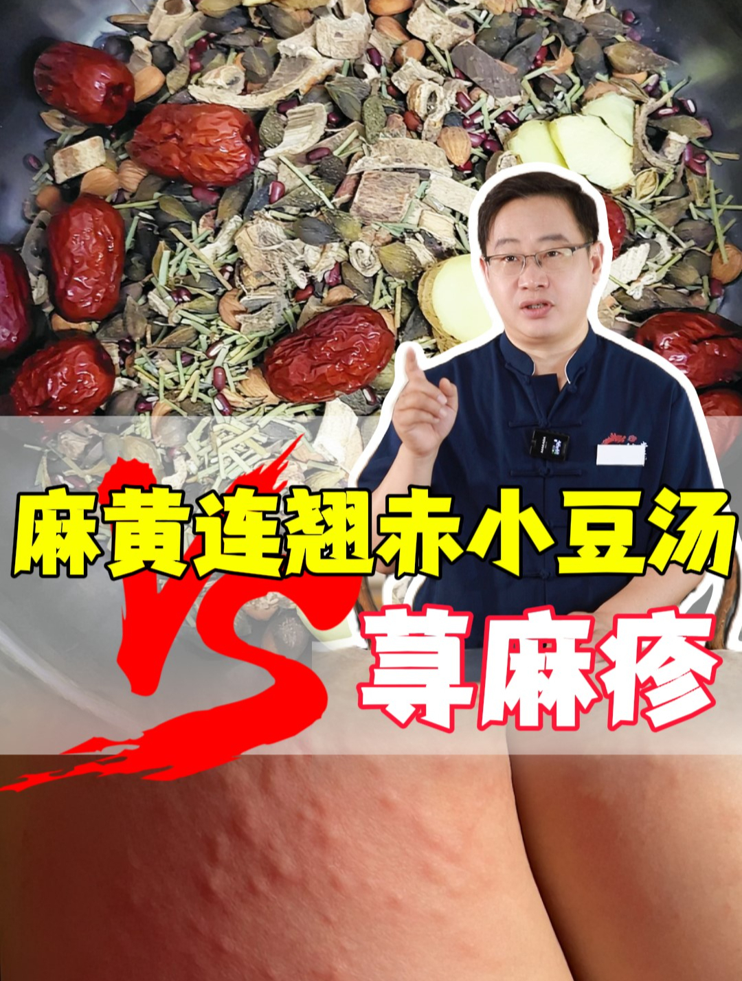 一碗麻黄连翘赤小豆汤,专解荨麻疹