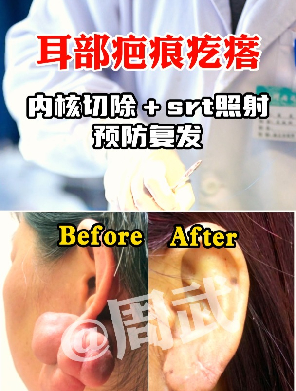 耳垂上长了个“核桃”大小的肉疙瘩,不敢漏出来吓人!