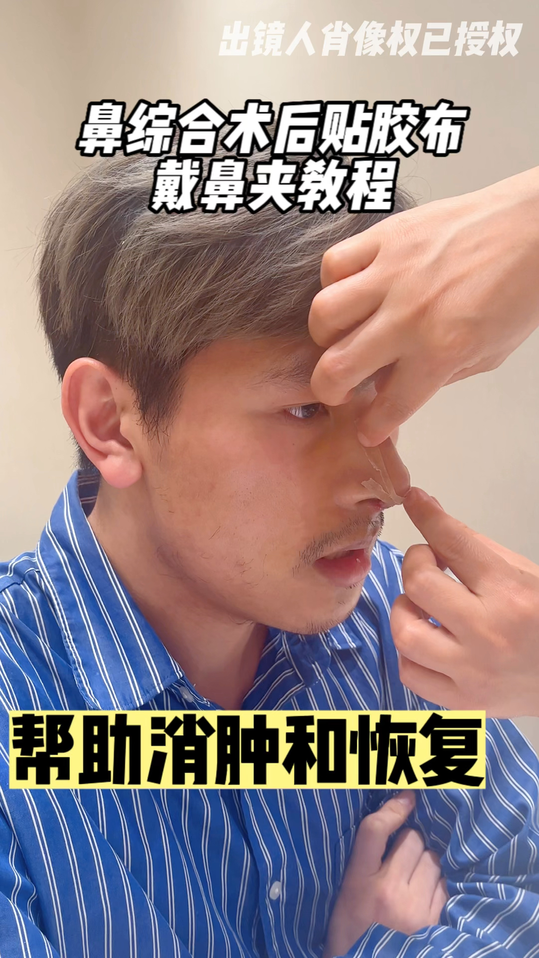 鼻综合术后贴胶布、戴鼻夹教程,建议收藏!隆鼻术后护理