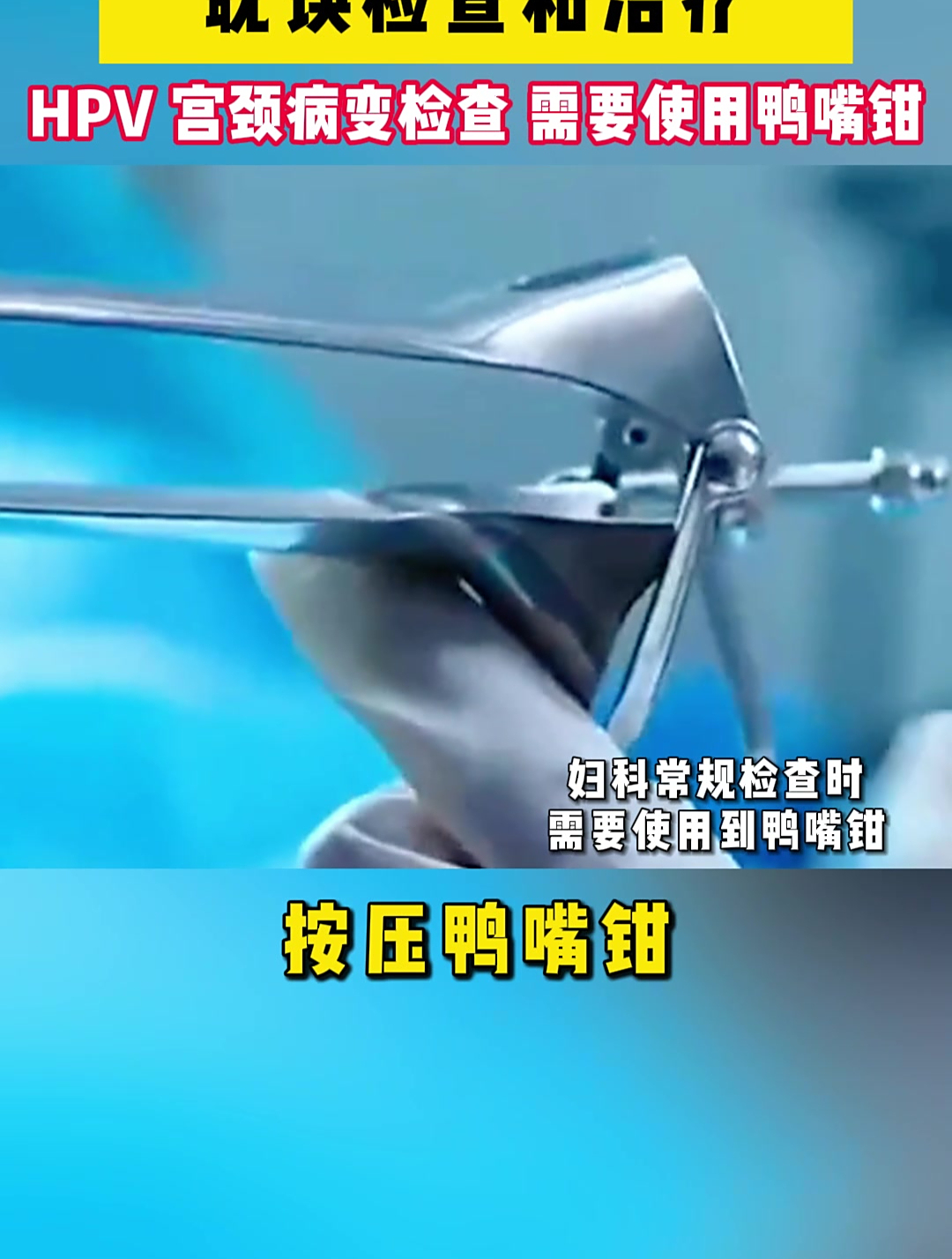 妇科用的鸭嘴钳、检查不疼!平时hpv /宫颈病变检查也会用到