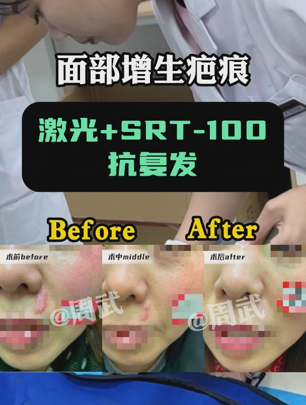 女生脸上长个肉疙瘩,刚开始以为问题不大!