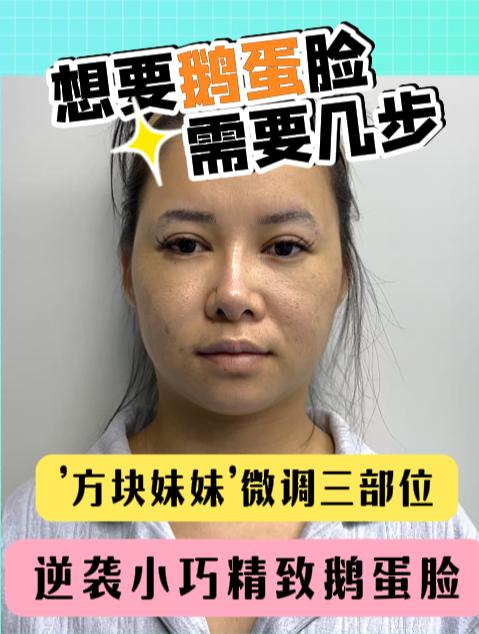 颧骨高+下颌肥厚,“方块妹妹”逆袭鹅蛋脸,变美需要哪几步?