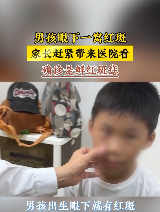 男孩眼下一窝红斑,家长赶紧带来医院看,确诊是鲜红斑痣