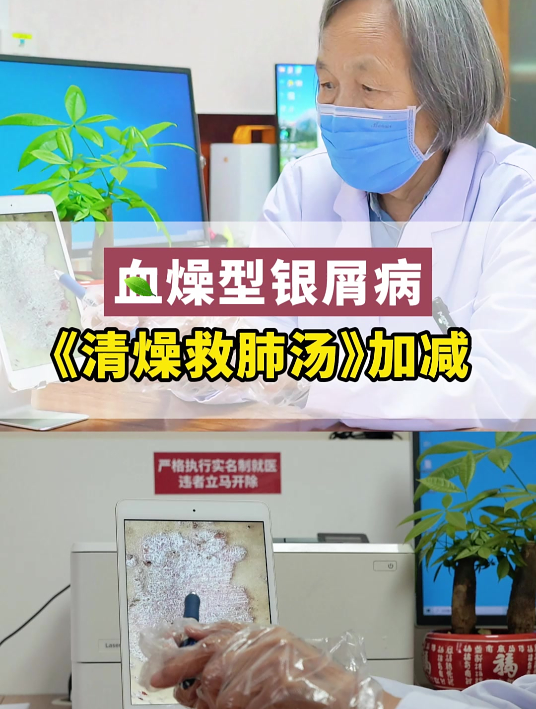 血燥型银屑病,《清燥救肺汤》加减!